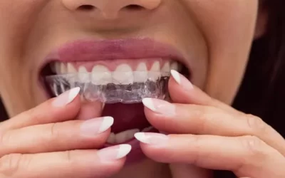 Invisalign Chattanooga: Clear Aligner Therapy for Discreet Orthodontic Correction